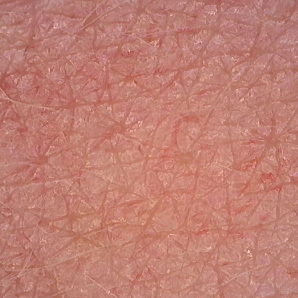 secchezza della pelle